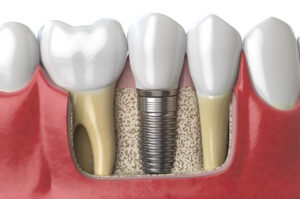 Implanty zębów – sprawdź, czy warto!